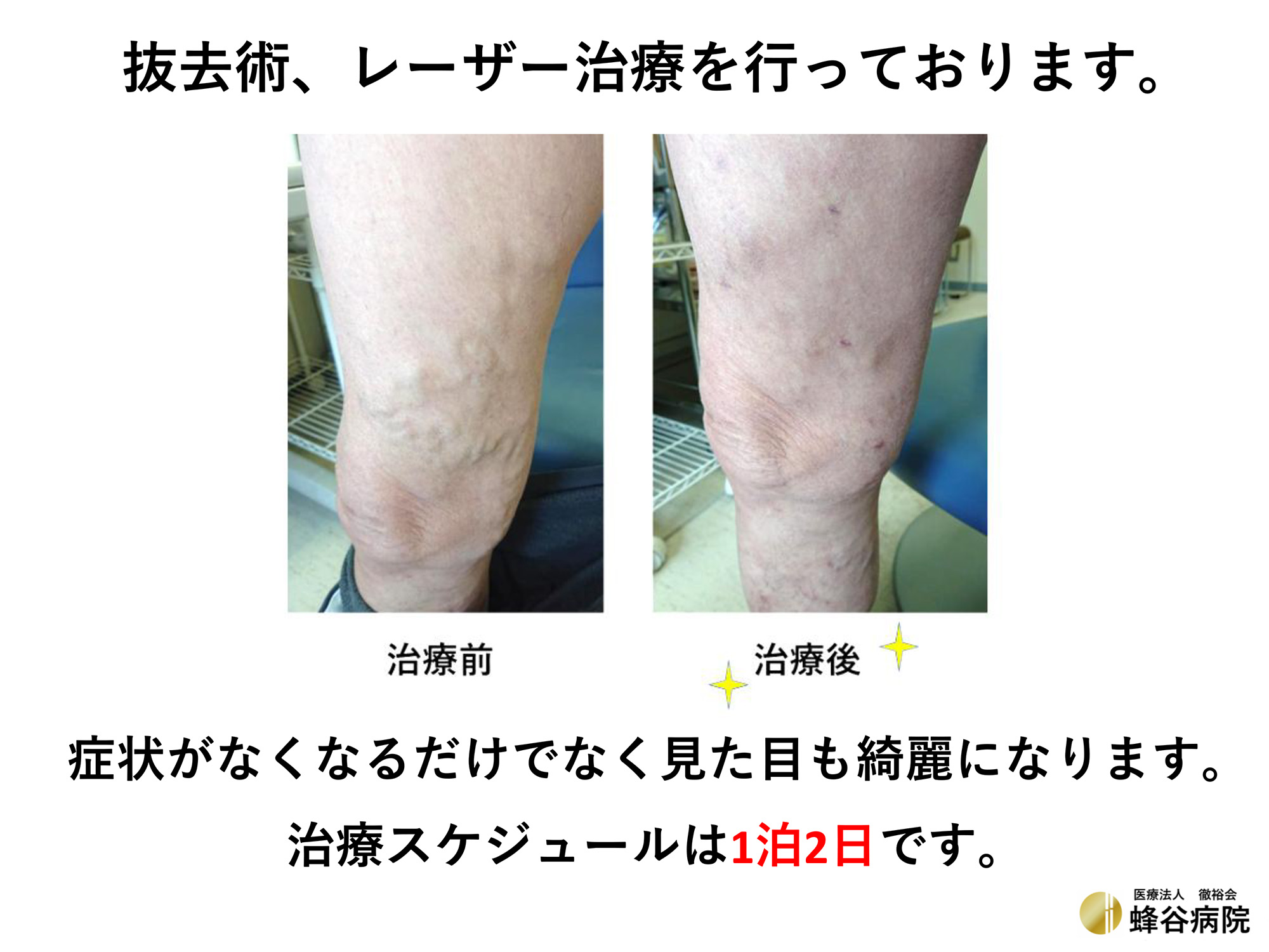 下肢静脈瘤　治療前と治療後
