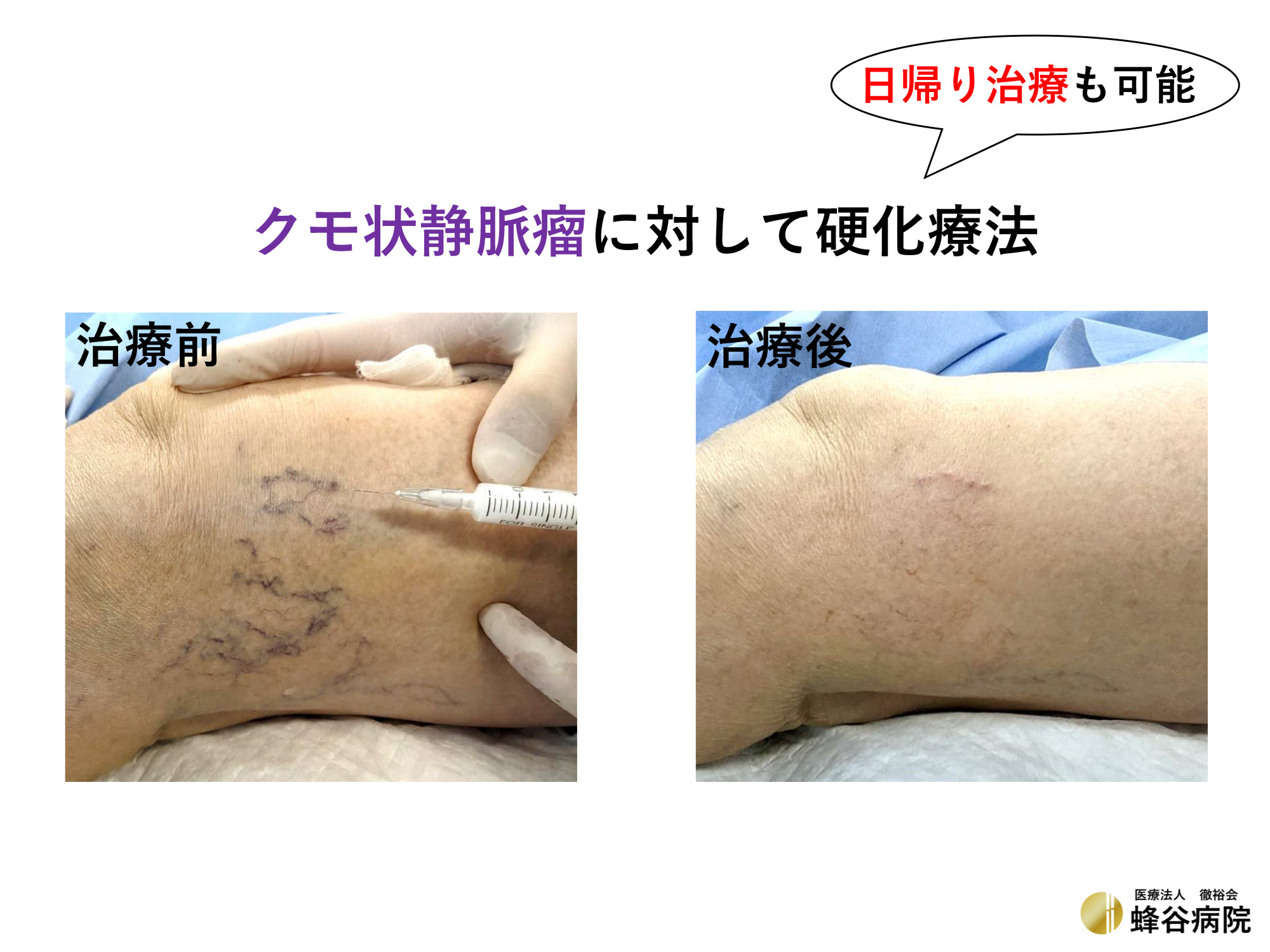 クモ状静脈瘤　治療前と治療後