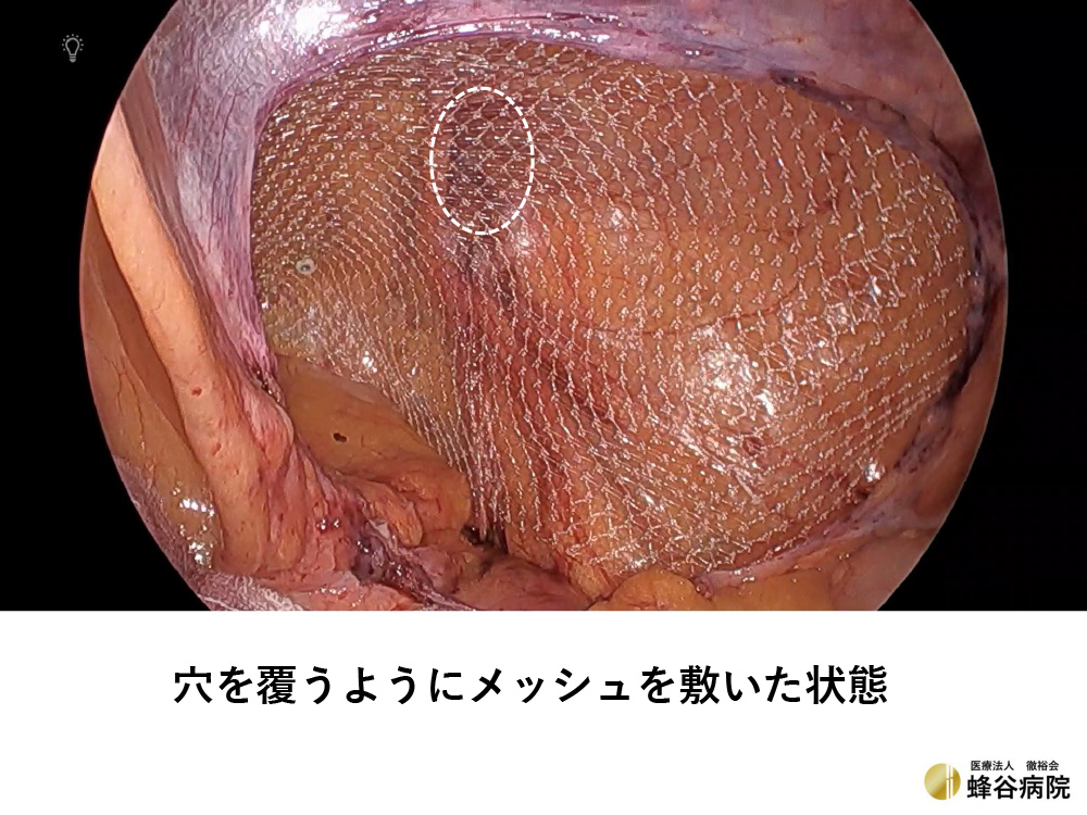 腹腔鏡下鼠径ヘルニア手術