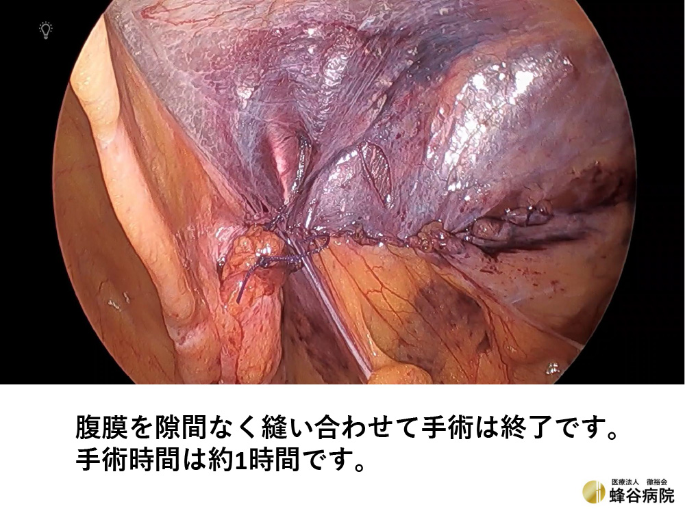 腹腔鏡下鼠径ヘルニア手術
